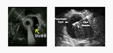 초음파 내시경의 적응증