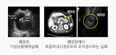 내시경 초음파검사(EUS)를 이용한 낭종배액 및 조직검사