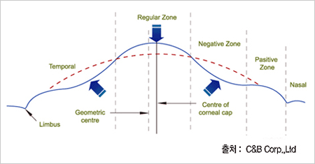 무수술 시력교정술의 교정원리