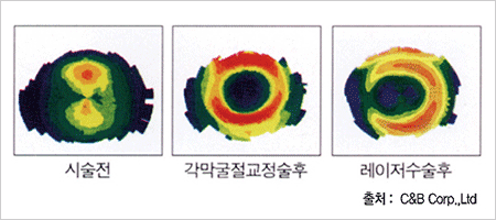 Contex OK Lens의 장점