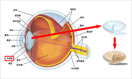 백내장 클리닉