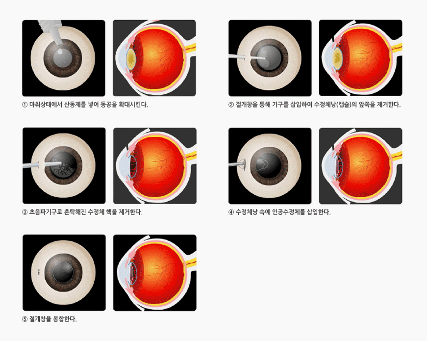 백내장 수술 방법