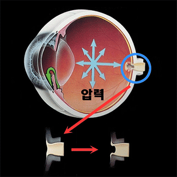 녹내장 클리닉