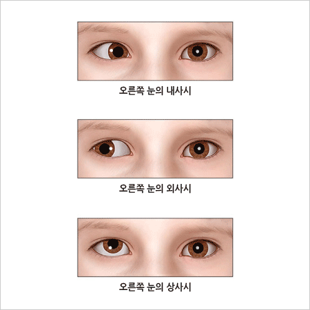 소아 및 사시, 신경안과 클리닉