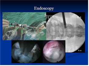요추부 경피적 내시경 디스크 제거술